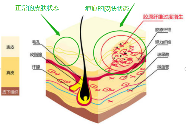 (痘痘)治疗好后留在两腮淋巴处的增生性痘疤怎