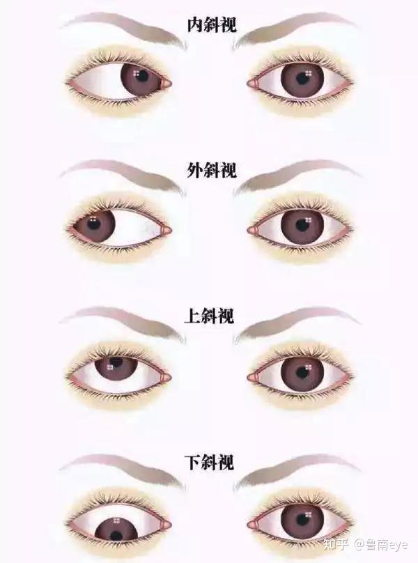 斜楞眼会随着年龄的增长恢复正常吗