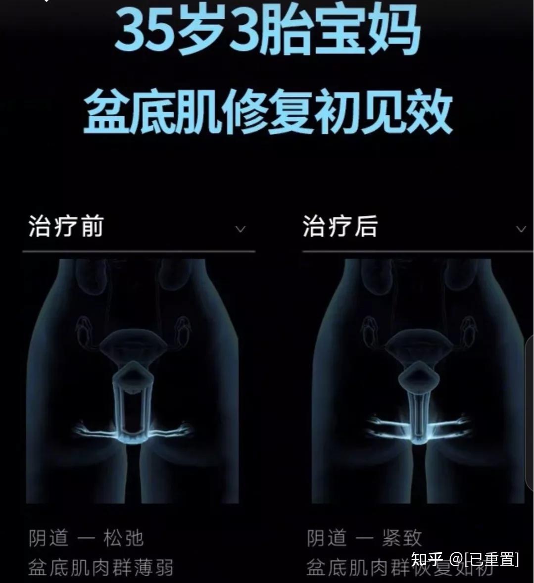 姚丁丁徒手骨盆修復能治療脫垂漏尿嗎