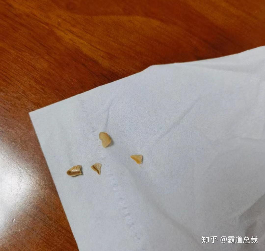 除了洗牙还有什么办法能清理牙结石?