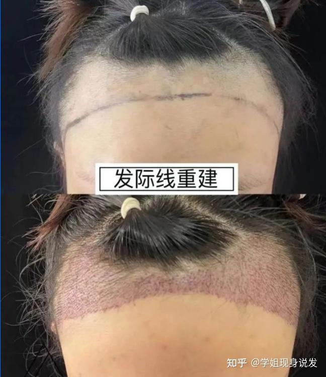 植发后偶尔吸烟(植发后抽烟了怎么补救)
