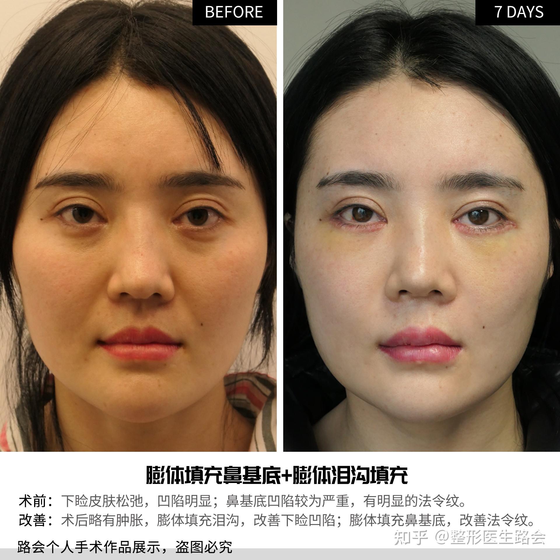 28岁去了一趟北京,填完鼻基底才明白:原来去法令纹这么简单! - 知乎