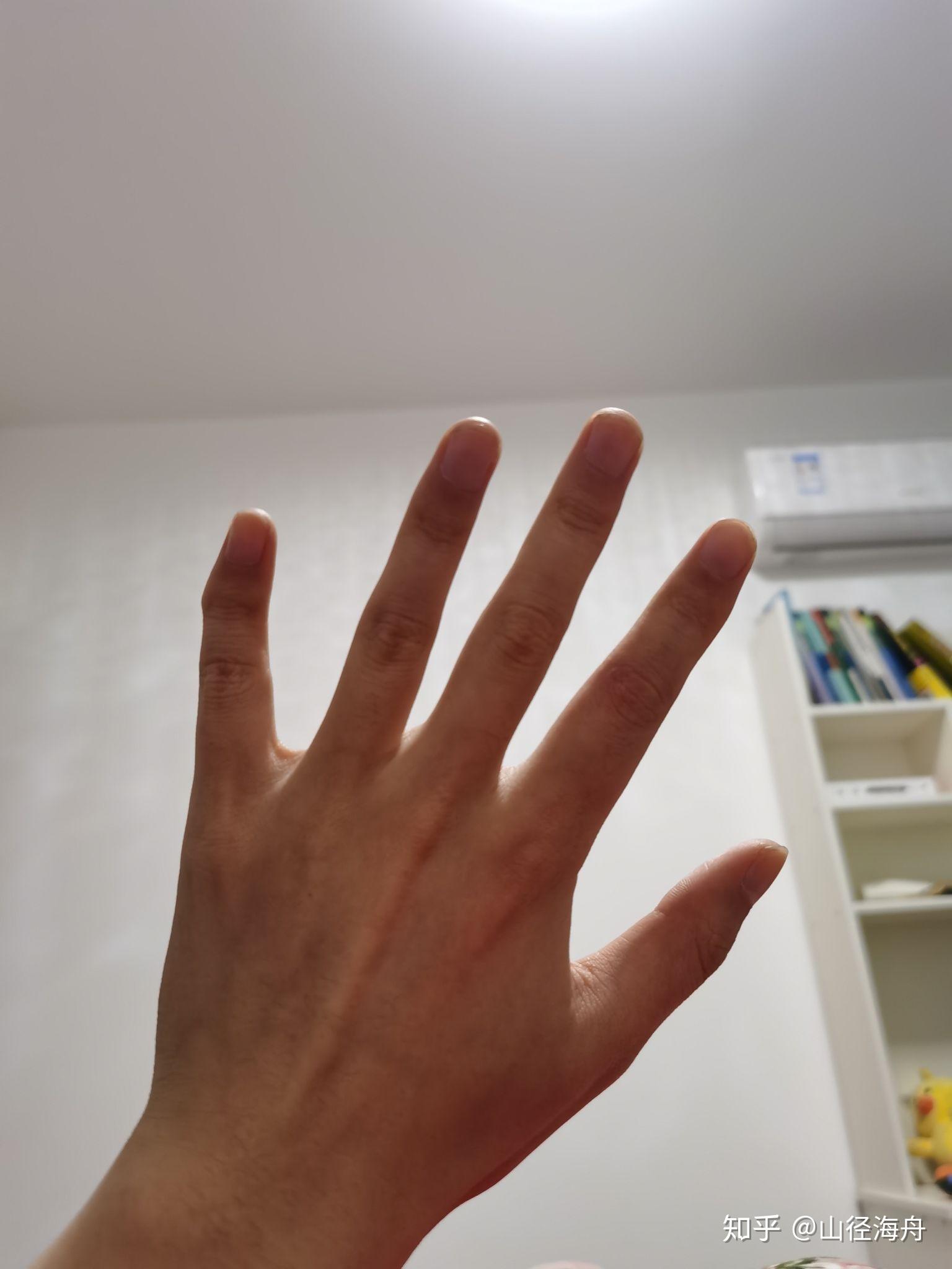 有没有天生小拇指向外弯曲的朋友? - 知乎