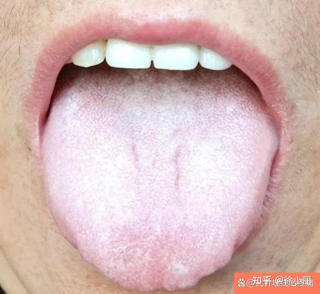 中医10种危重舌象详解——扎针埋线治疼痛 - 知乎