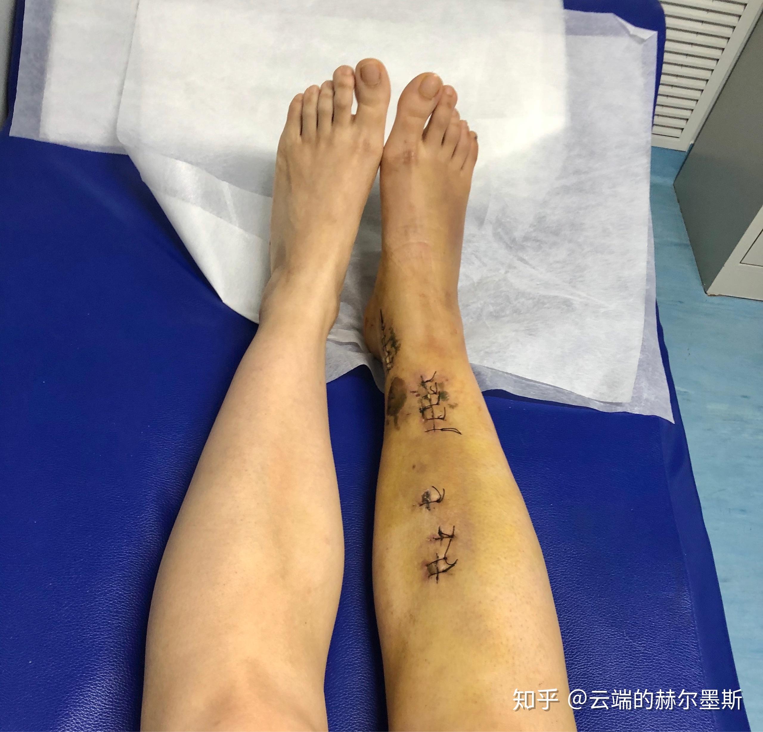 骨折一个月康复日记|一枚女汉子胫腓骨骨折治疗康复全记录(持续更新)