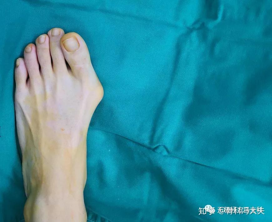 大脚骨拇外翻矫形手术