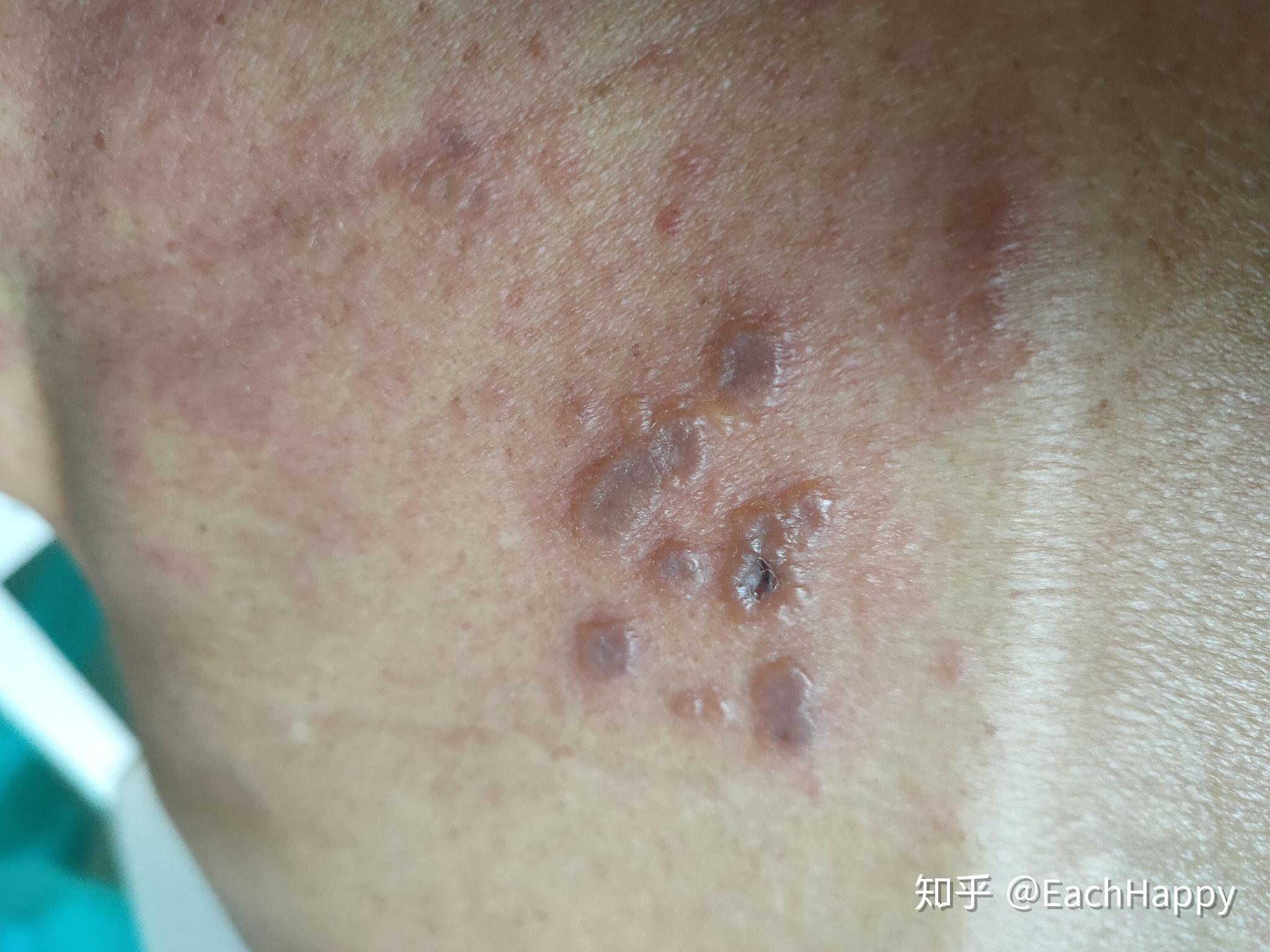 家父皮肤结痂开始脱皮彻底好了