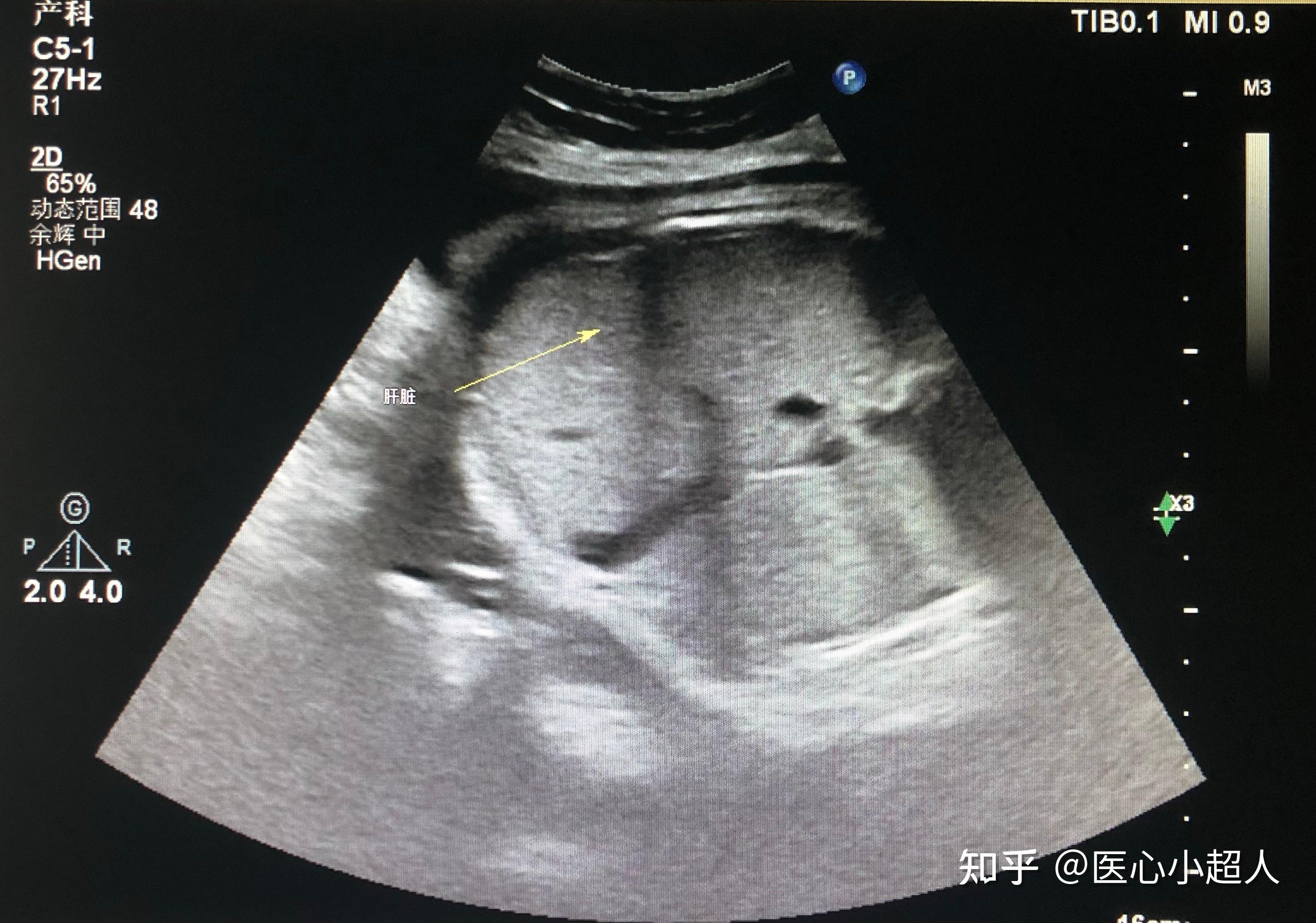 正常早期妊娠子宫超声所见（二） - 知乎
