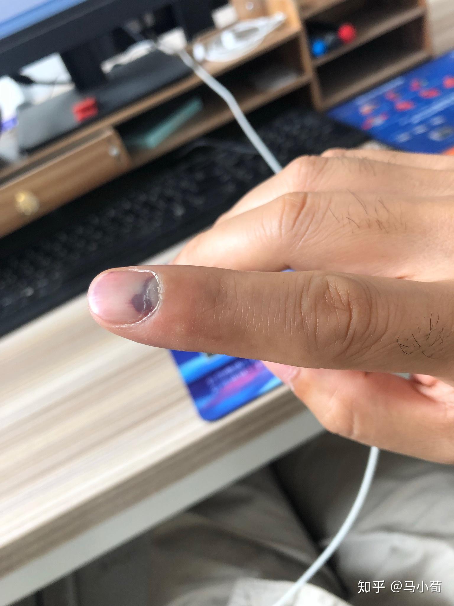 手指被挤伤恢复过程