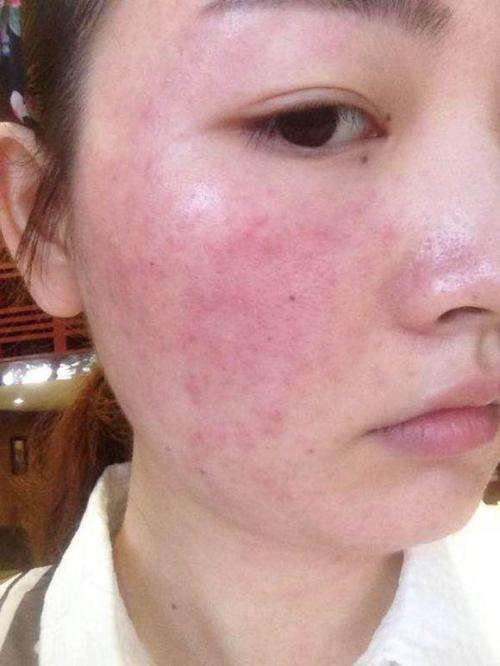 那么激素脸需要排毒吗?如果这个问题被放