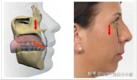 舌头贴上颚,能让鼻基底变高、脸变立体变好看? - 知乎
