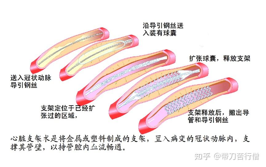 心脏搭桥、支架手术原理示意图分享 - 知乎
