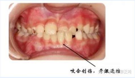 地包天怎么办?要正畸还是正颌? - 知乎