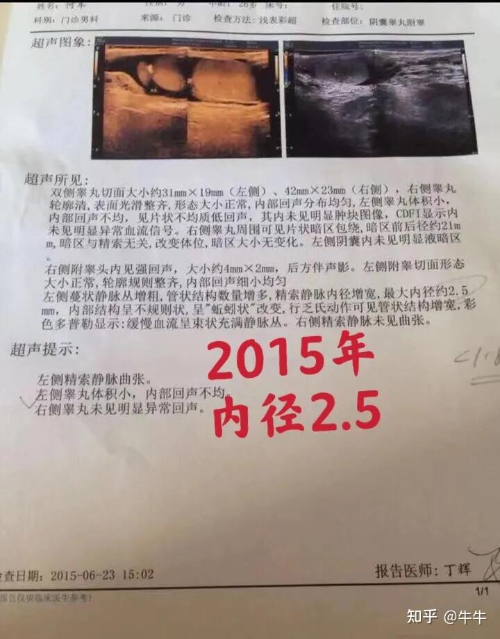 什么样才算精索静脉曲张 v2-e64548cd47157ad71e9a12fb16eb86d3_r.jpg