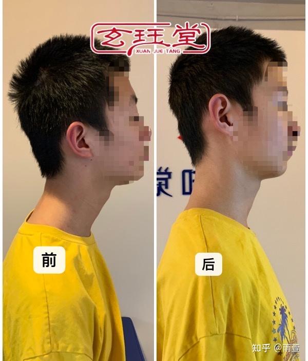 头前伸不要只关注颈椎，还要考虑髋屈肌和臀大肌 - 知乎