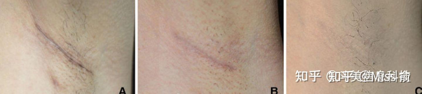 四,手术切口巨小,疤痕隐形效果好的医生案例