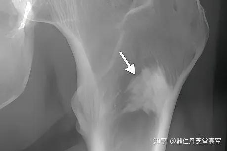 膝关节骨岛是怎么一回事?