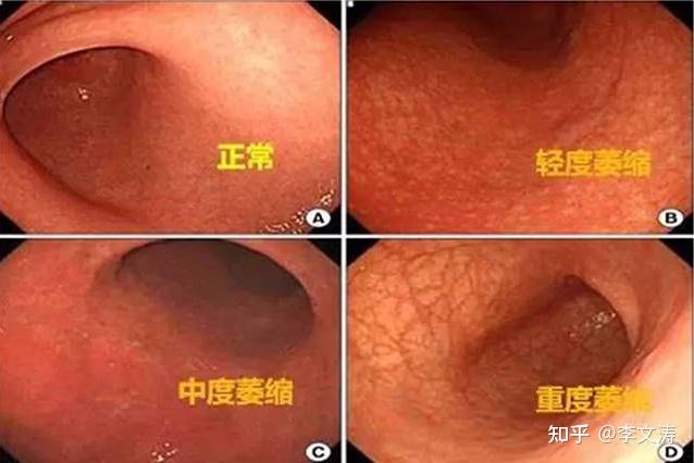 慢性萎缩性胃炎作为胃癌最常见的癌前疾病,其癌变的预警和早期发现