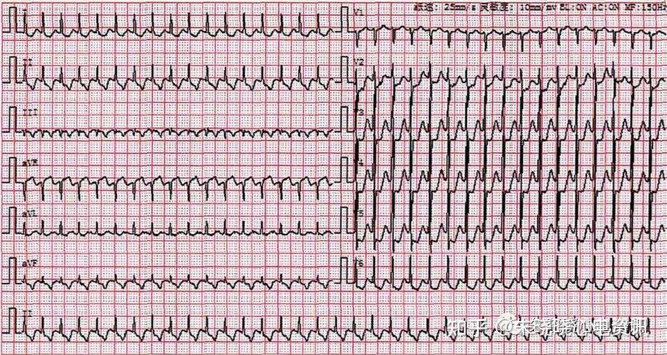 心电危急值之快速性心律失常
