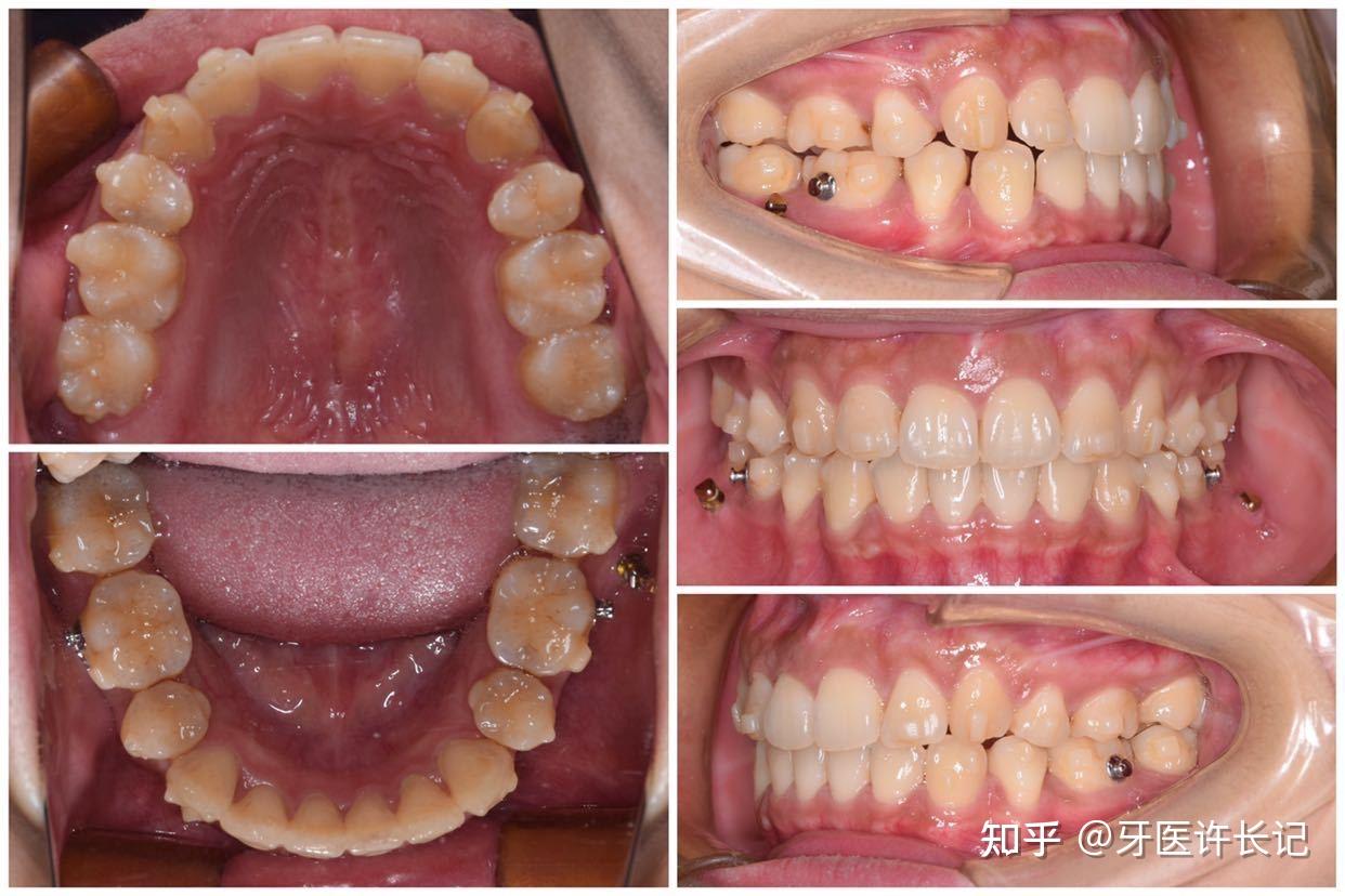 青岛牙齿矫正|「牙齿前突」案例：如何通过正畸让面部线条更加精致？ - 知乎