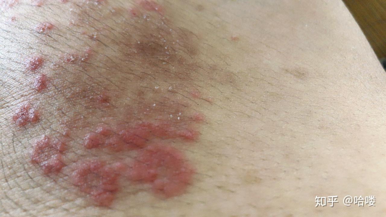 谁知道这是什么皮肤病很痒年年复发也去过皮肤医院