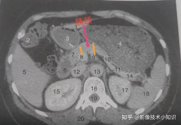 胰腺影像解剖 - 知乎