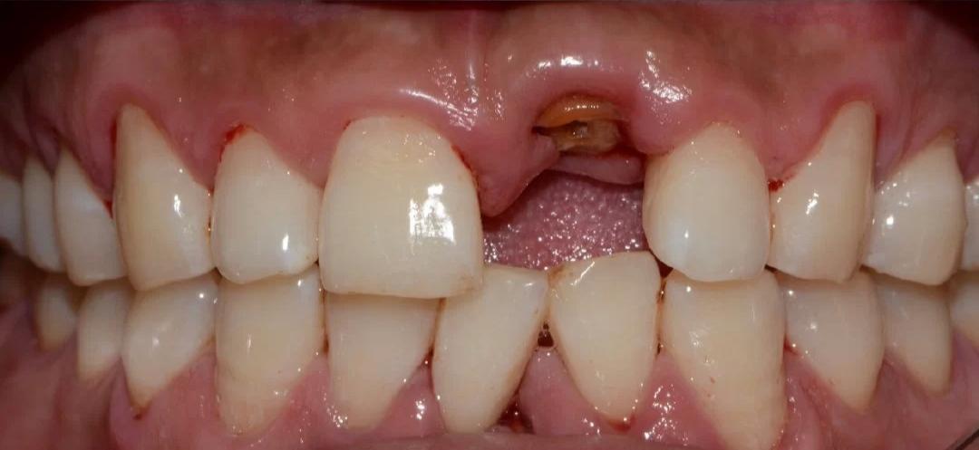 别再拖了再拖几百的补牙就要变成上万的种植牙了