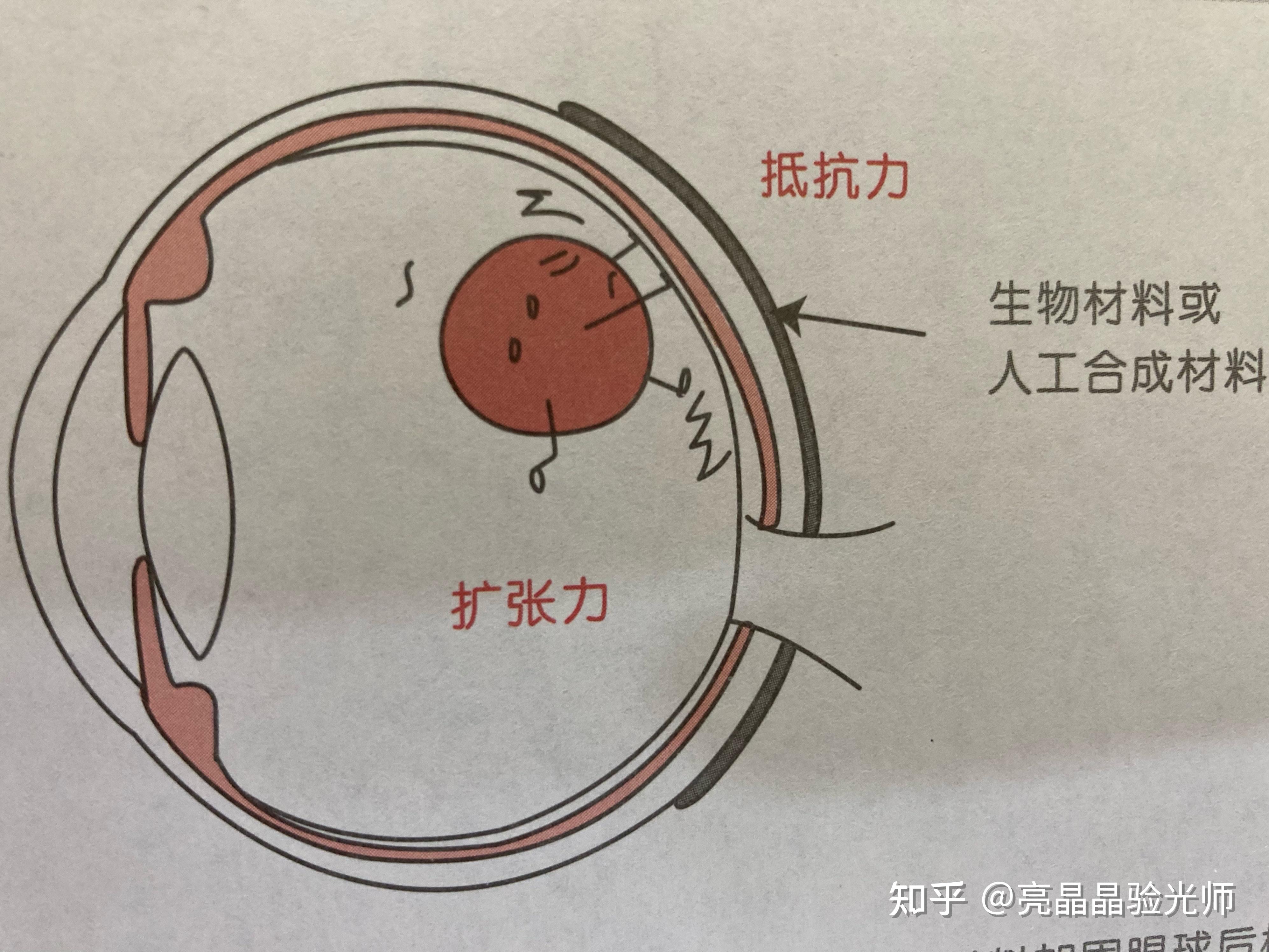 对中高度近视伴周边视网膜裂孔,变性和玻璃体牵拉,或对侧眼已经出现