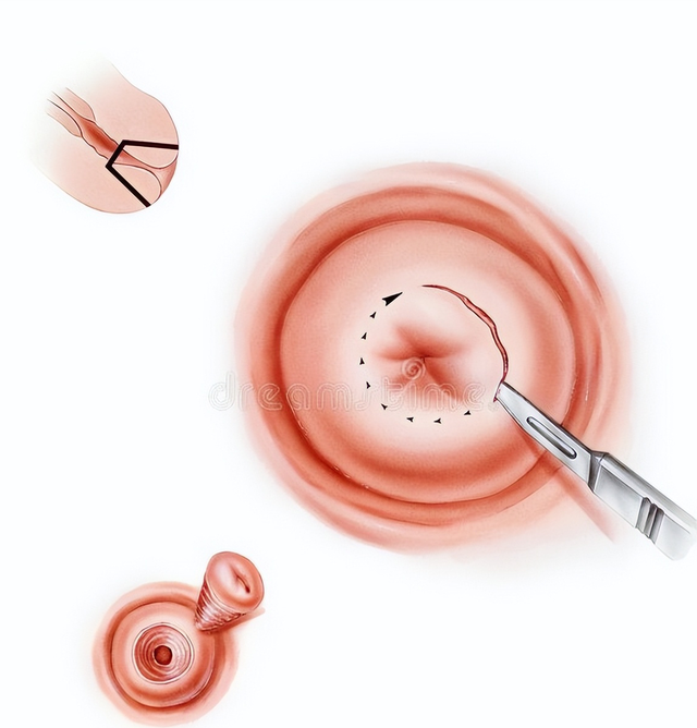 宫颈激光锥切术操作简便,组织愈合快,并发症少,但设备价格昂贵,国内