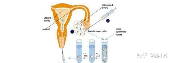 ivm试管一次多少钱(试管婴儿ivf是什么意思)-第1张图片-鲸幼网