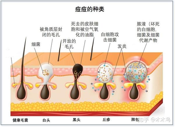 胰岛素/igf-1与痘痘的关系