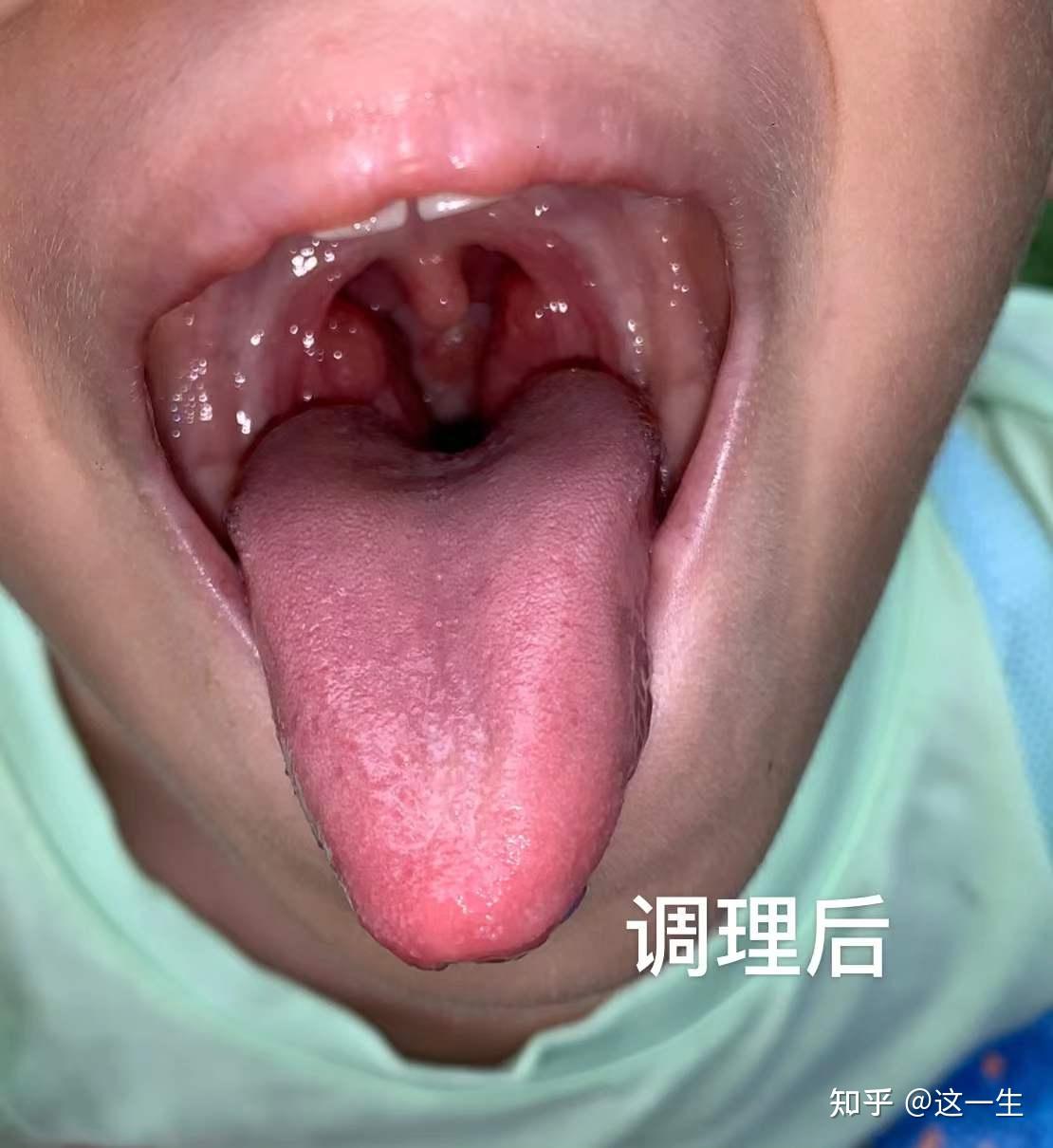 孩子有疳积中医这样调理