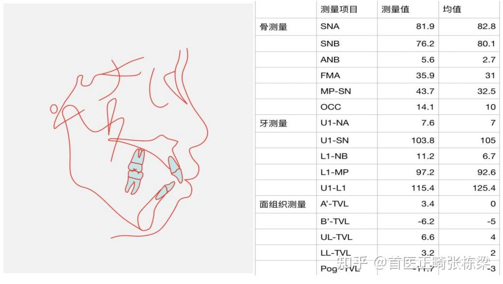 北京牙齒矯正有哪些醫院推薦價格多少錢合適骨性嘴凸牙齒矯正可以改善