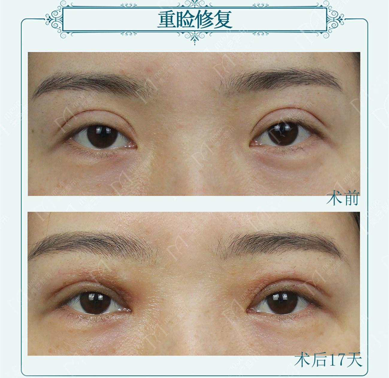 12mm宽平行双眼皮修复开扇形术后17天眼睛变化