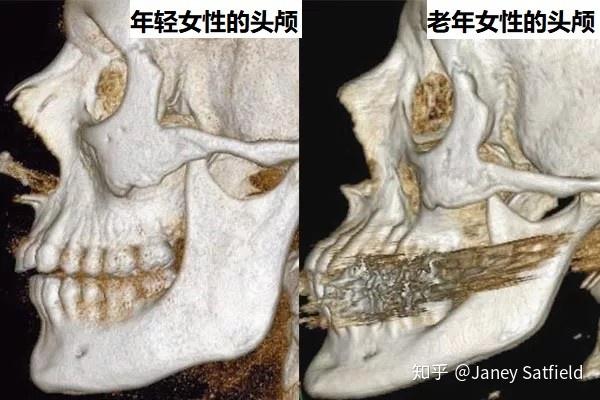 这是一张青春与衰老面部骨骼的变化的对比图.