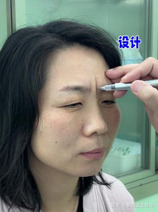 重度川字纹，填充没作用？一刀“切”干净利索！ - 知乎