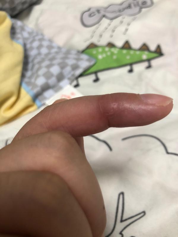 伤口愈合后为什么会凸起能自愈吗 知乎