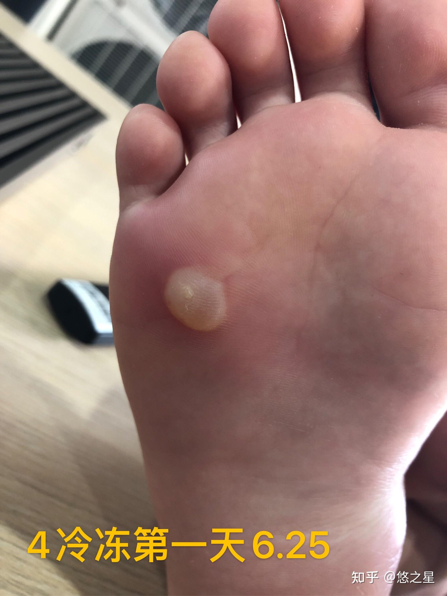 跖疣冷冻终于好了