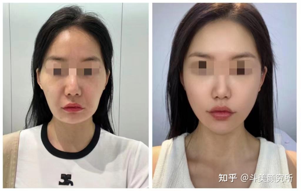 面颊凹陷的原因是什么？如何才能有效改善