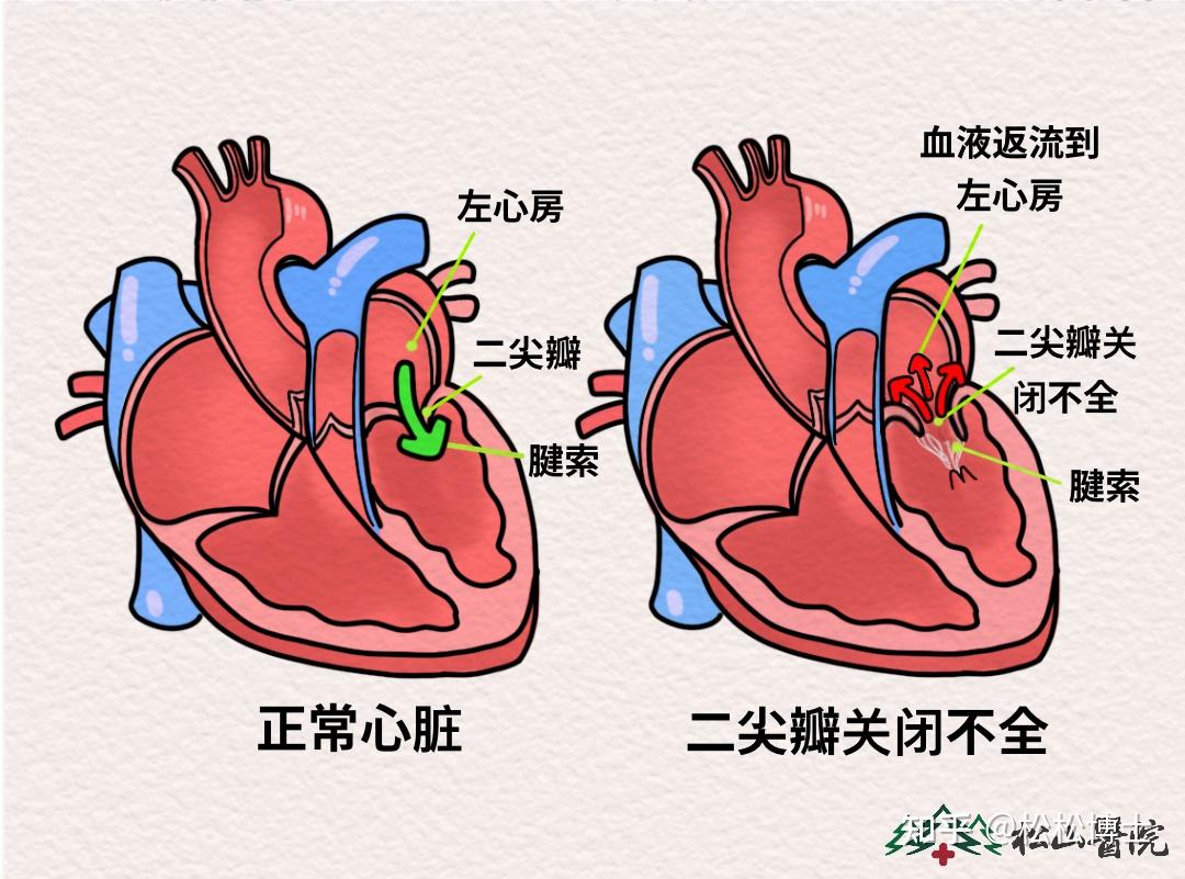 二尖瓣尖瓣图片