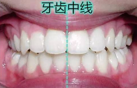 测一测:你的咬合关系是否正常!
