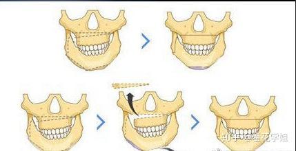 上颌lefort i 型截骨术(改善面中部外形)