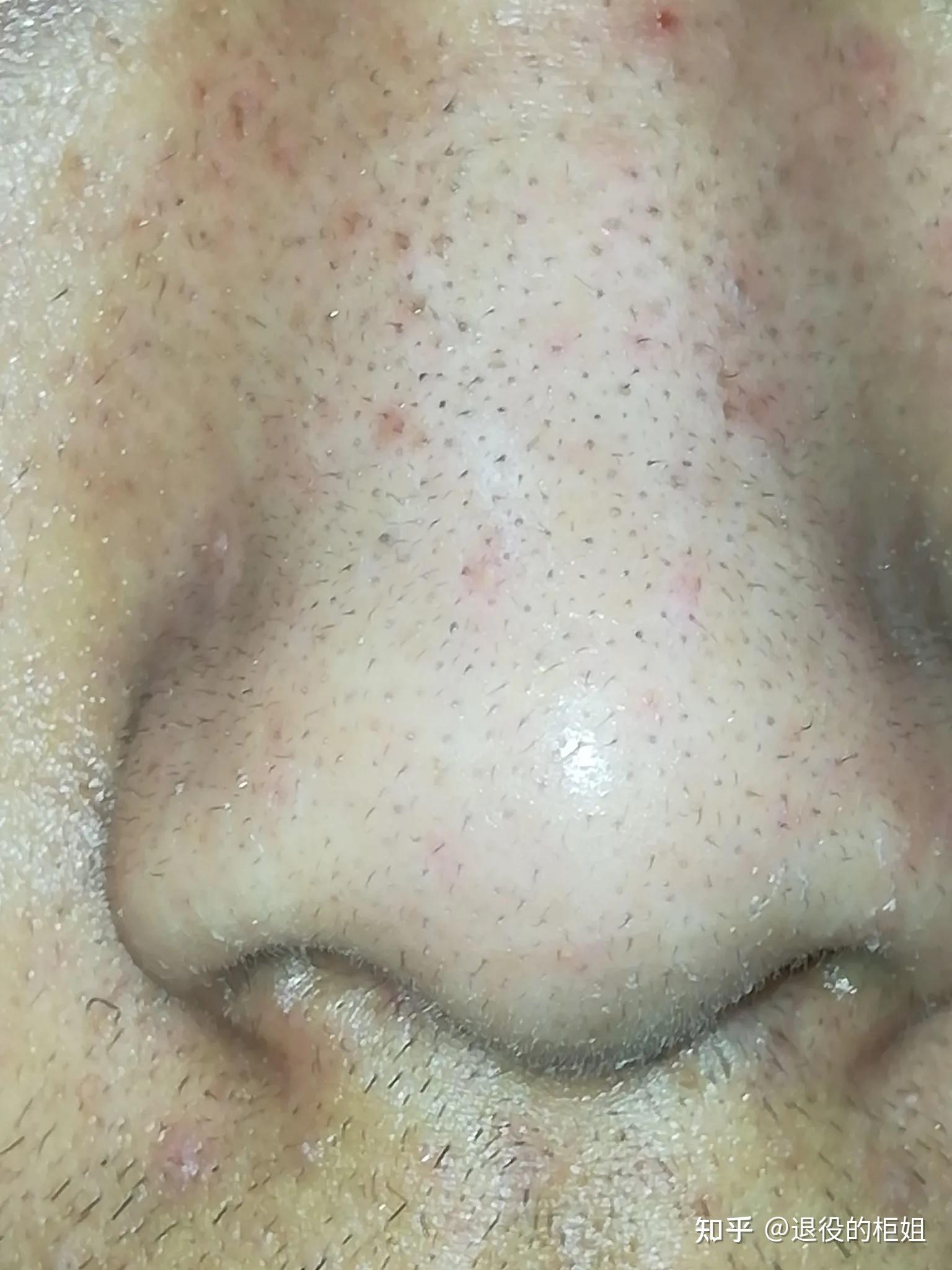 美容院的韩国超微小气泡是什么去黑头效果好吗自己可以在家里做吗