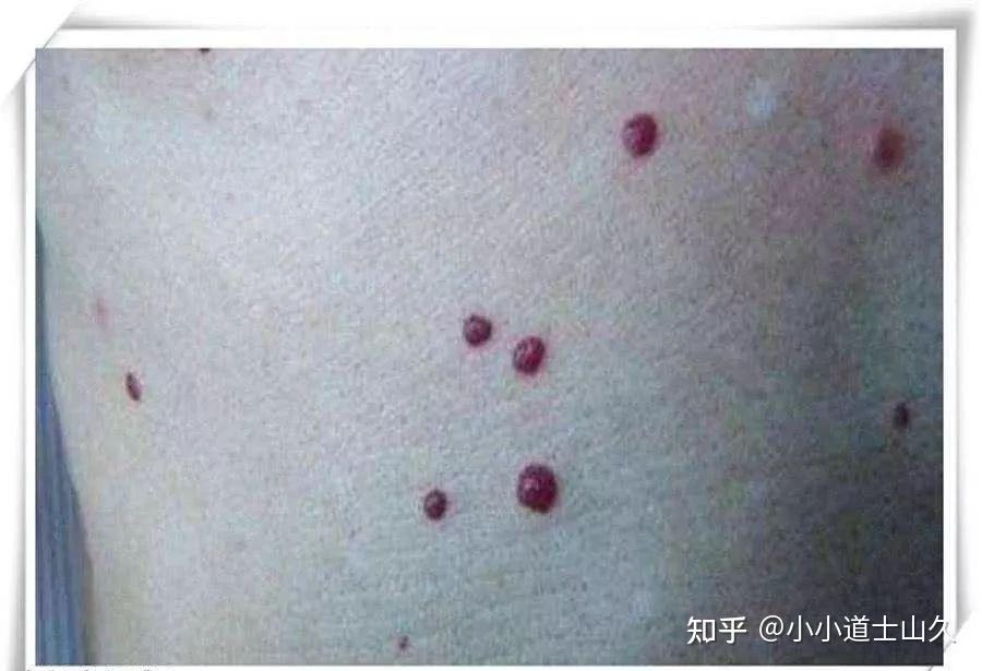 【道医养生】身上长出这种“奇怪颜色”的痣,要小心 - 知乎