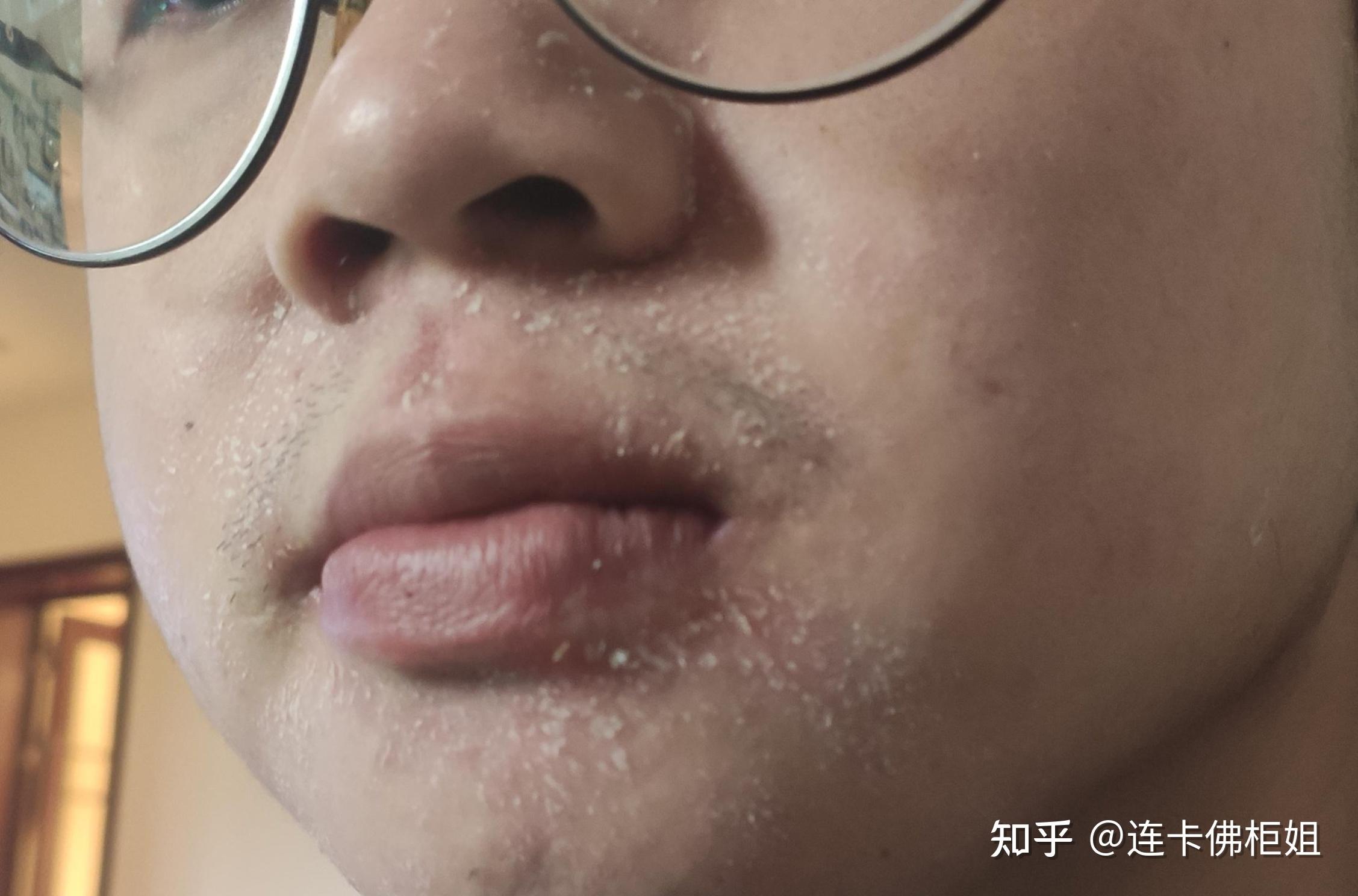 秋冬皮肤干燥,爆炸起皮,还红敏刺痛该怎么办? - 知乎