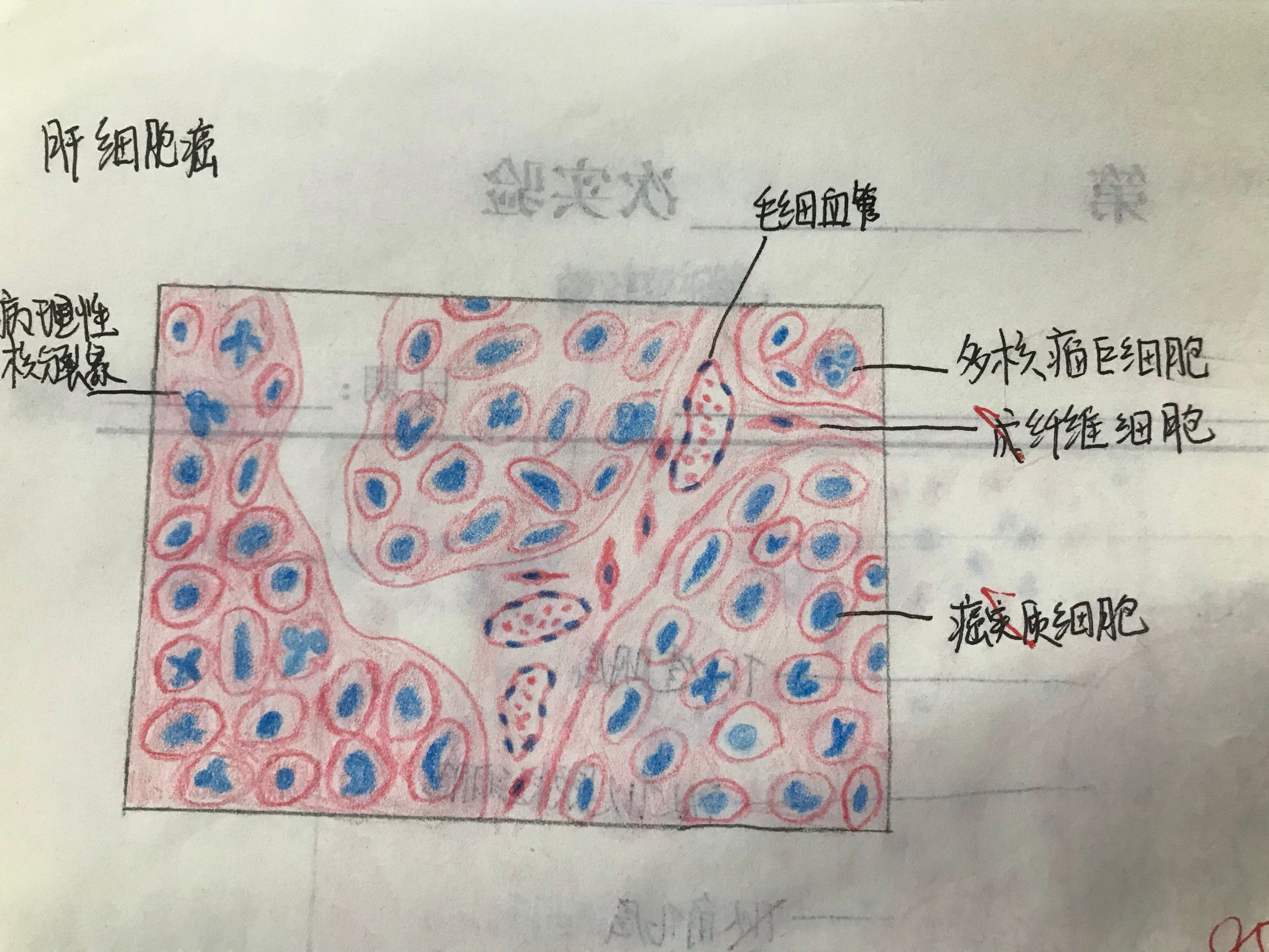 葡萄胎绘图图片