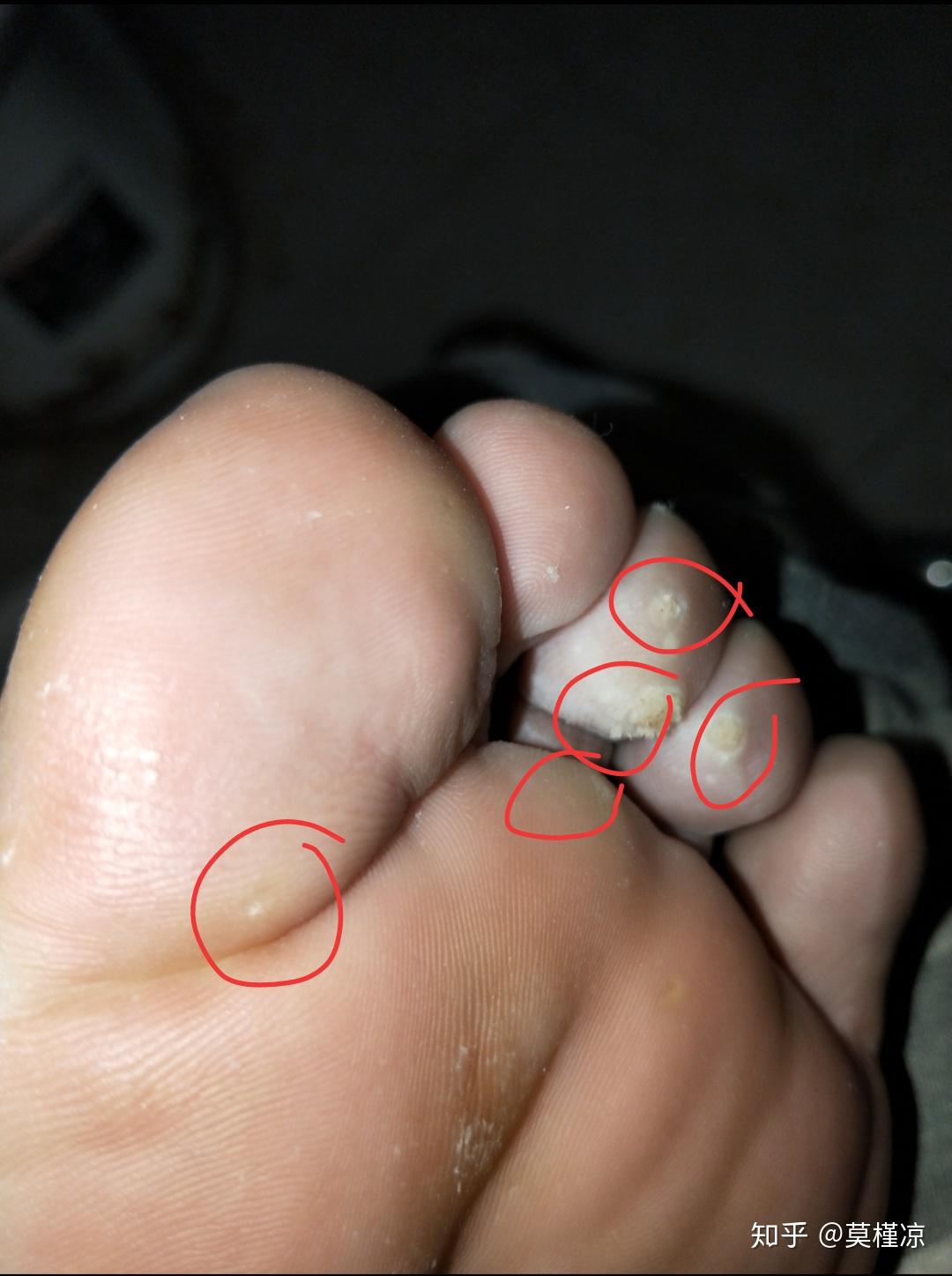 关于怎么治好自己莫名其妙得的跖疣