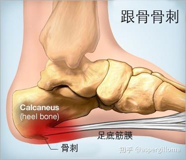 跟骨骨刺保守治疗无效后可以考虑微创手术治疗 知乎