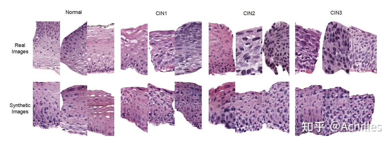 宫颈癌医学图像分析宫颈图像与组织玻片