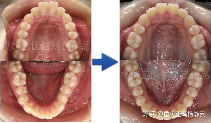 矫治方案:拔除上颌两个4号牙,排齐牙齿,下颌扩大牙弓,上颌微种植体